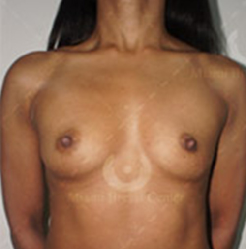 Natural-Breast-Augmentation-Patient-18 | Before Natural Breast Augmentation