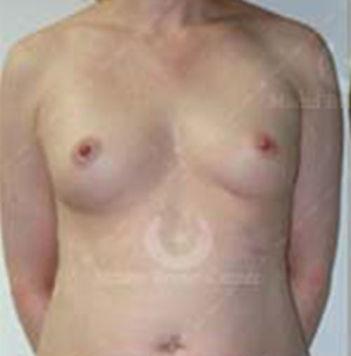 Natural-Breast-Augmentation-Patient-04 | Before Breast