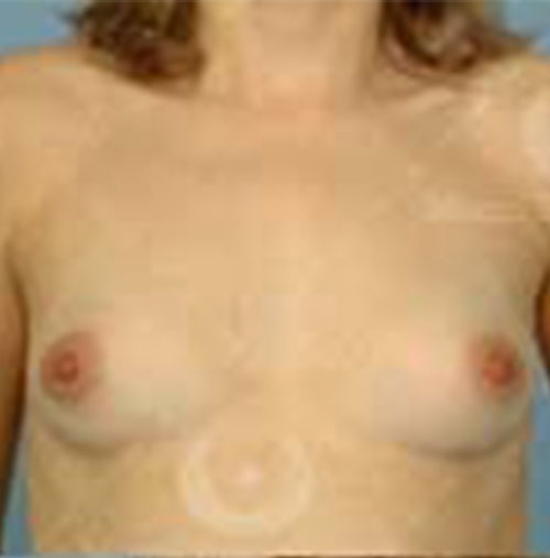 Natural-Breast-Augmentation-Patient-06 | Before Breast