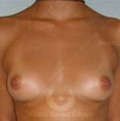 Natural-Breast-Augmentation-Patient-07 | Before Breast