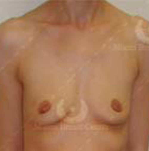 Natural-Breast-Augmentation-Patient-09 | Before Breast