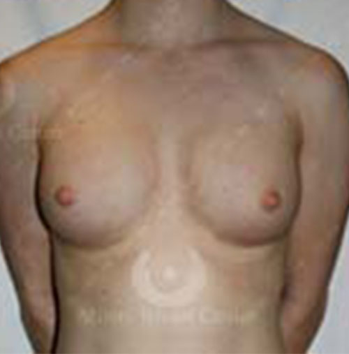 Natural-Breast-Augmentation-Patient-16 | After Natural Breast Augmentation