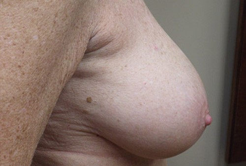 Natural-Breast-Augmentation-Patient-20 | After Natural Breast Augmentation