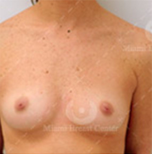 Natural-Breast-Augmentation-Patient-01 | Before Natural Breast Augmentation