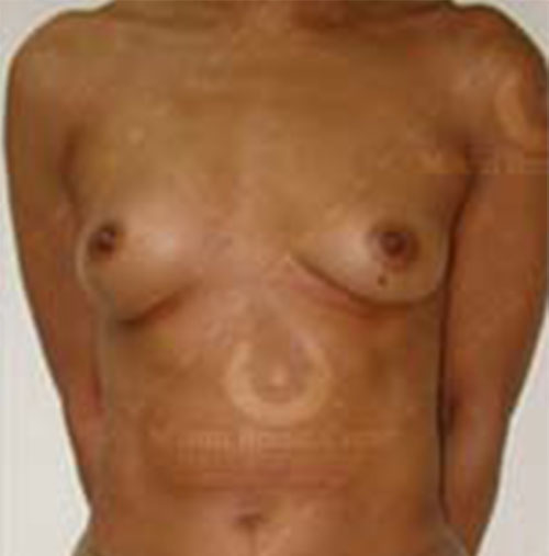 Natural-Breast-Augmentation-Patient-13 | Before Natural Breast Augmentation