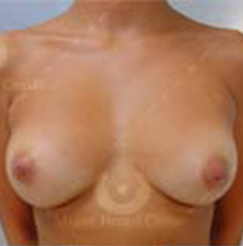 Natural-Breast-Augmentation-Patient-08 | After Breast
