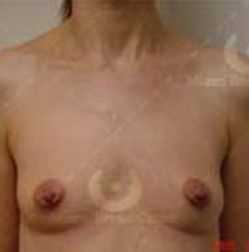 Natural-Breast-Augmentation-Patient-08 | Before Breast