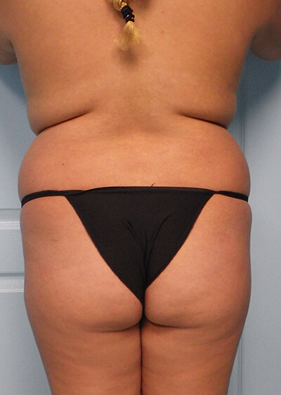 Butt-Augmentation-Patient-03 | Before Body