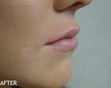Injectable-Fillers-Patient-03 | After Non-Surgical