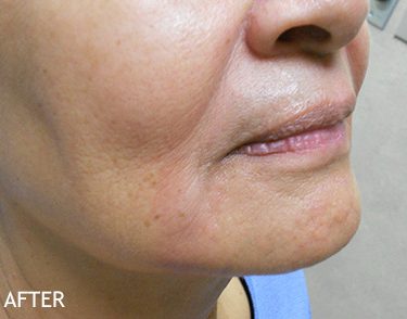 Injectable-Fillers-Patient-04 | After Non-Surgical