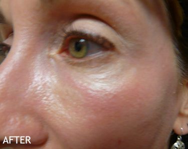 Injectable-Fillers-Patient-05 | After Non-Surgical