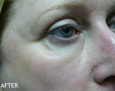 Injectable-Fillers-Patient-06 | After Non-Surgical