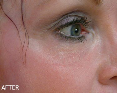 Injectable-Fillers-Patient-07 | After Non-Surgical