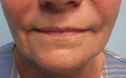 Injectable-Fillers-Patient-09 | Before Non-Surgical