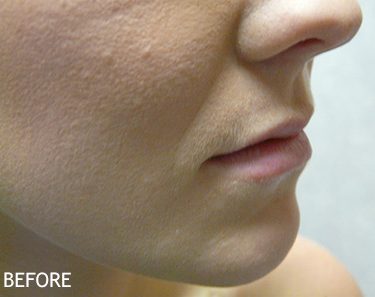 Injectable-Fillers-Patient-03 | Before Non-Surgical