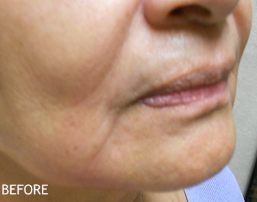 Injectable-Fillers-Patient-04 | Before Non-Surgical