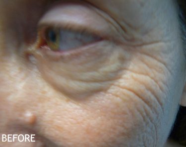 Injectable-Fillers-Patient-05 | Before Non-Surgical