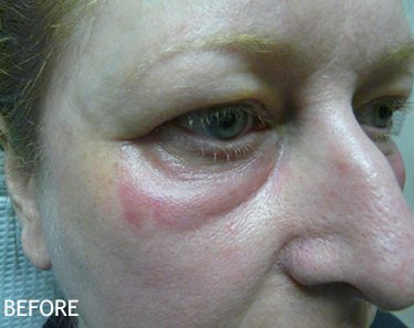 Injectable-Fillers-Patient-06 | Before Non-Surgical