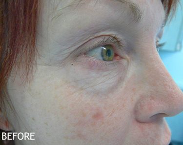 Injectable-Fillers-Patient-07 | Before Non-Surgical