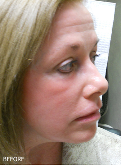 Injectable-Fillers-Patient-08 | Before Non-Surgical