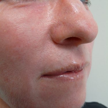 Injectable-Fillers-Patient-01 | After Non-Surgical