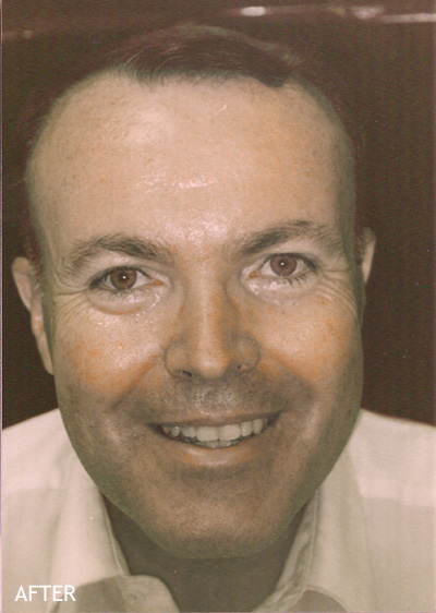 Liposculpture-Patient-02 | After Liposculpture