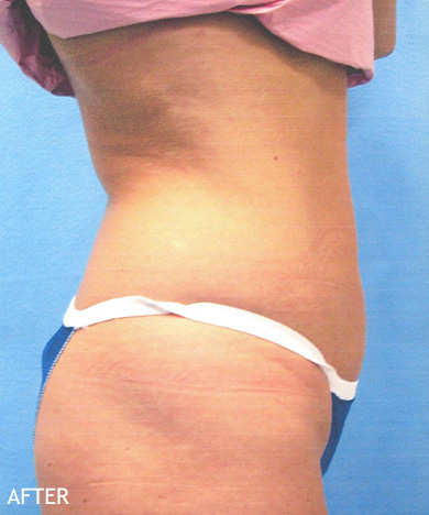Liposculpture-Patient-05 | After Liposculpture