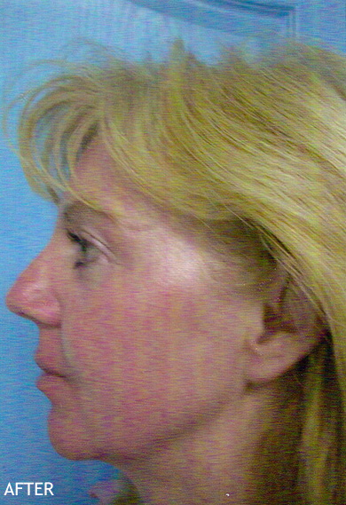 Liposculpture-Patient-06 | After Liposculpture