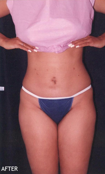 Liposculpture-Patient-08 | After Liposculpture