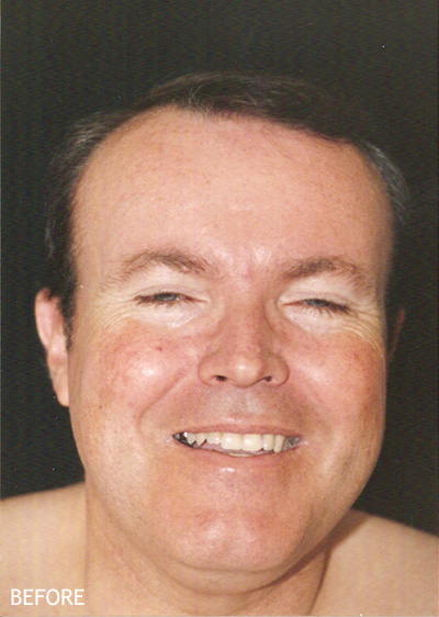 Liposculpture-Patient-02 | Before Liposculpture