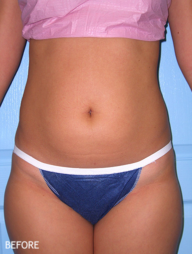 Liposculpture-Patient-03 | Before Liposculpture