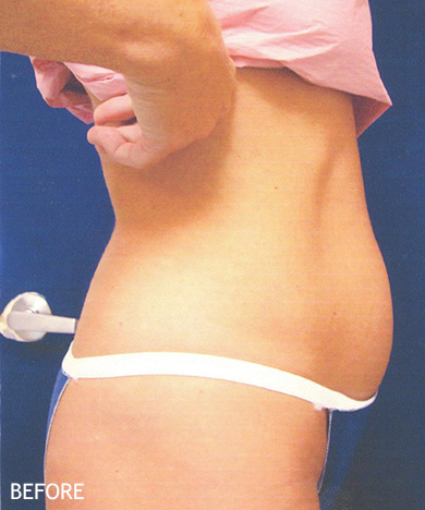 Liposculpture-Patient-05 | Before Liposculpture