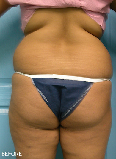 Liposculpture-Patient-07 | Before Liposculpture