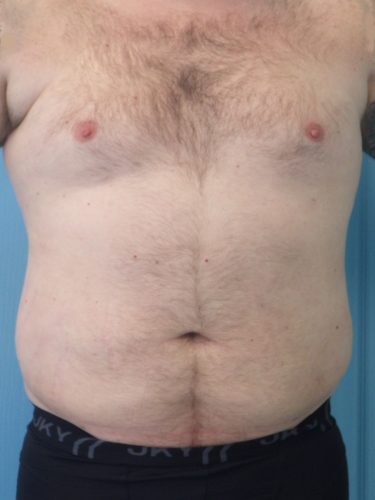 Liposculpture-Patient-09 | After Liposculpture