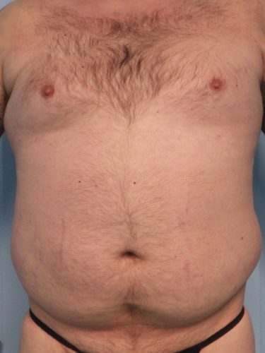 Liposculpture-Patient-09 | Before Liposculpture