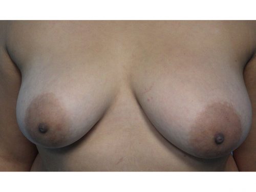 Natural-Breast-Augmentation-Patient-22 | Before Breast