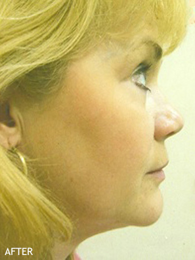 Neck-Lift-Patient-01 | After Neck Lift