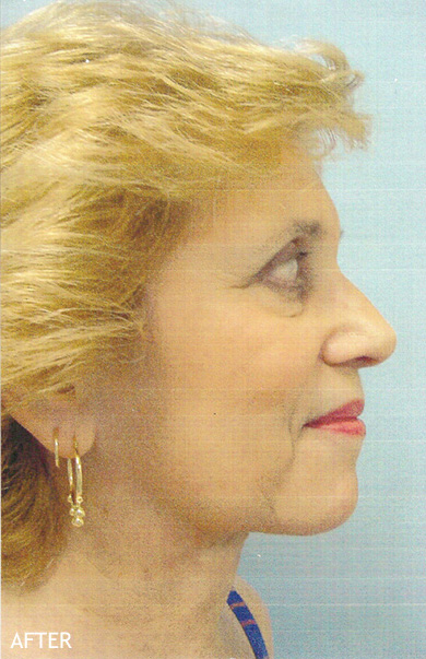 Neck-Lift-Patient-03 | After Neck Lift