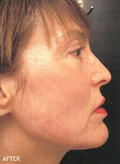 Neck-Lift-Patient-04 | After Neck Lift