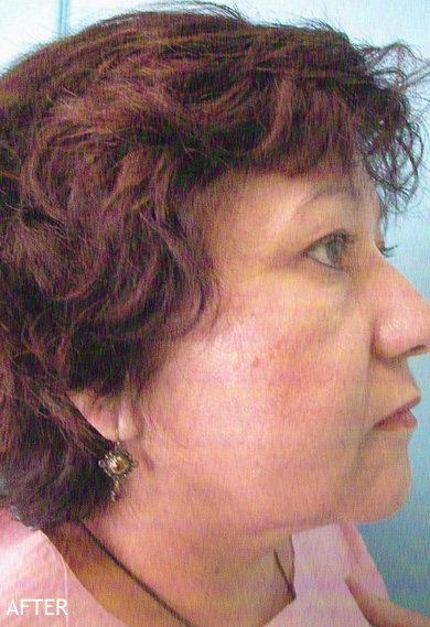 Neck-Lift-Patient-05 | After Neck Lift