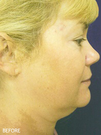 Neck-Lift-Patient-01 | Before Neck Lift