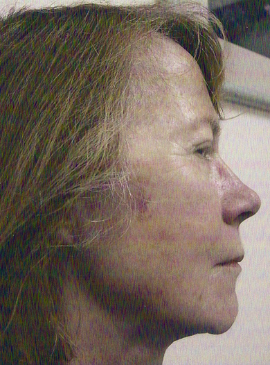 Neck-Lift-Patient-02 | Before Neck Lift