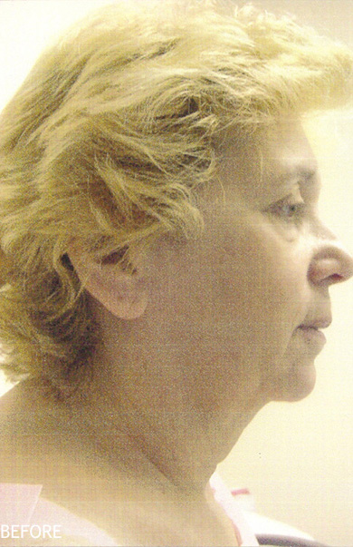 Neck-Lift-Patient-03 | Before Neck Lift