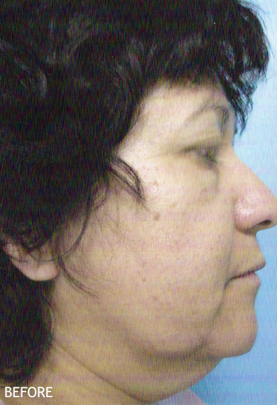 Neck-Lift-Patient-05 | Before Neck Lift
