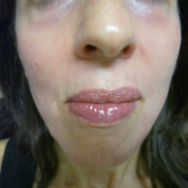 Injectable-Fillers-Patient-02 | After Non-Surgical