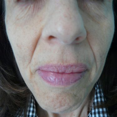 Injectable-Fillers-Patient-02 | Before Non-Surgical