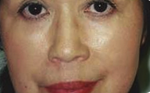 Skin-Lesion-Removal-Patient-01 | After Skin Lesion Removal