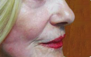 Skin-Lesion-Removal-Patient-02 | After Skin Lesion Removal