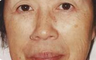 Skin-Lesion-Removal-Patient-01 | Before Skin Lesion Removal