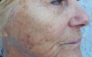 Skin-Lesion-Removal-Patient-02 | Before Skin Lesion Removal